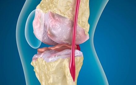 Development reasons for the arthrosis of the knee joint